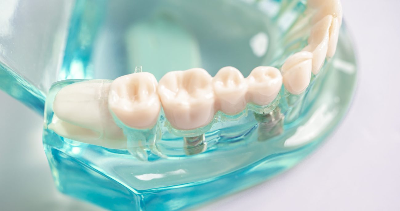 Dental implant, artificial tooth roots into jaw, root canal of dental treatment, gum disease, teeth model for dentist studying about dentistry.